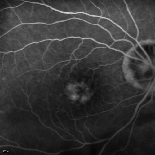 Lumigan (Bimatoprost) Cystoid Macular Edema - Eye Better 1 month after Stopping Lumigan
 82-year-old man had cataract surgery in 1993.  He has had glaucoma for seven or eight years for a long time.  He is taking Lumigan only in the left eye.  About a year ago he started in the right eye and then starting just about a few months ago he has noticed intermittent blurring in the vision in the right eye. Vision 20/25 OD, 20/20 OS
