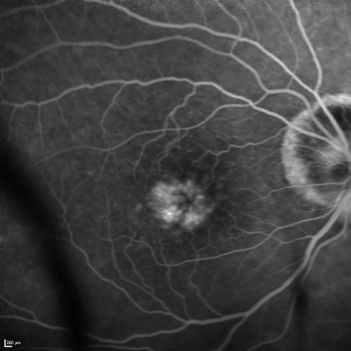 Lumigan (Bimatoprost) Cystoid Macular Edema - Eye Better 1 month after Stopping Lumigan
 82-year-old man had cataract surgery in 1993.  He has had glaucoma for seven or eight years for a long time.  He is taking Lumigan only in the left eye.  About a year ago he started in the right eye and then starting just about a few months ago he has noticed intermittent blurring in the vision in the right eye. Vision 20/25 OD, 20/20 OS
