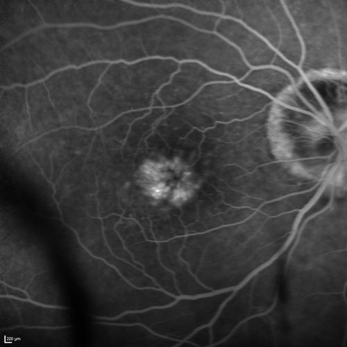 Lumigan (Bimatoprost) Cystoid Macular Edema - Eye Better 1 month after Stopping Lumigan
 82-year-old man had cataract surgery in 1993.  He has had glaucoma for seven or eight years for a long time.  He is taking Lumigan only in the left eye.  About a year ago he started in the right eye and then starting just about a few months ago he has noticed intermittent blurring in the vision in the right eye. Vision 20/25 OD, 20/20 OS
