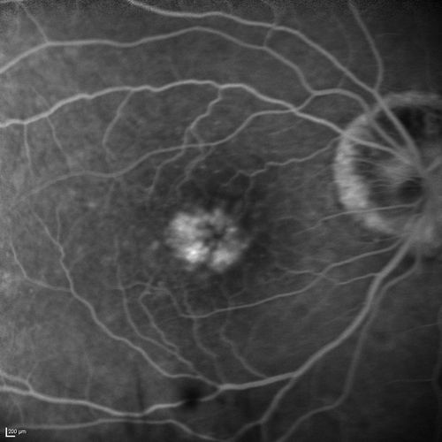 Lumigan (Bimatoprost) Cystoid Macular Edema - Eye Better 1 month after Stopping Lumigan
 82-year-old man had cataract surgery in 1993.  He has had glaucoma for seven or eight years for a long time.  He is taking Lumigan only in the left eye.  About a year ago he started in the right eye and then starting just about a few months ago he has noticed intermittent blurring in the vision in the right eye. Vision 20/25 OD, 20/20 OS

