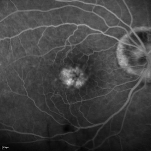 Lumigan (Bimatoprost) Cystoid Macular Edema - Eye Better 1 month after Stopping Lumigan
 82-year-old man had cataract surgery in 1993.  He has had glaucoma for seven or eight years for a long time.  He is taking Lumigan only in the left eye.  About a year ago he started in the right eye and then starting just about a few months ago he has noticed intermittent blurring in the vision in the right eye. Vision 20/25 OD, 20/20 OS
