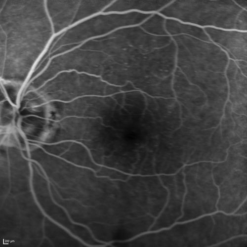 Lumigan (Bimatoprost) Cystoid Macular Edema - Eye Better 1 month after Stopping Lumigan
 82-year-old man had cataract surgery in 1993.  He has had glaucoma for seven or eight years for a long time.  He is taking Lumigan only in the left eye.  About a year ago he started in the right eye and then starting just about a few months ago he has noticed intermittent blurring in the vision in the right eye. Vision 20/25 OD, 20/20 OS
