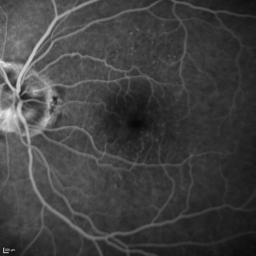 Lumigan (Bimatoprost) Cystoid Macular Edema - Eye Better 1 month after Stopping Lumigan
 82-year-old man had cataract surgery in 1993.  He has had glaucoma for seven or eight years for a long time.  He is taking Lumigan only in the left eye.  About a year ago he started in the right eye and then starting just about a few months ago he has noticed intermittent blurring in the vision in the right eye. Vision 20/25 OD, 20/20 OS
