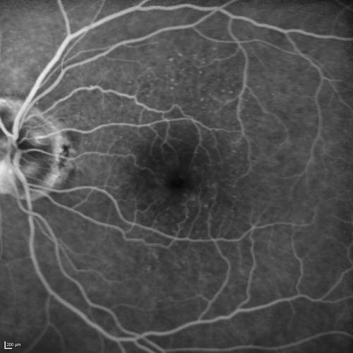 Lumigan (Bimatoprost) Cystoid Macular Edema - Eye Better 1 month after Stopping Lumigan
 82-year-old man had cataract surgery in 1993.  He has had glaucoma for seven or eight years for a long time.  He is taking Lumigan only in the left eye.  About a year ago he started in the right eye and then starting just about a few months ago he has noticed intermittent blurring in the vision in the right eye. Vision 20/25 OD, 20/20 OS

