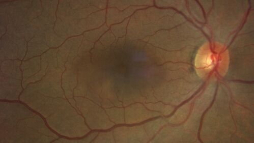Pseudophakic cystoid macular edema (CME)
66 year old female 4 months following cataract surgery.  Never had very good vision after surgery.  On PF QID for one month.  VA 20/50 in both eyes.
