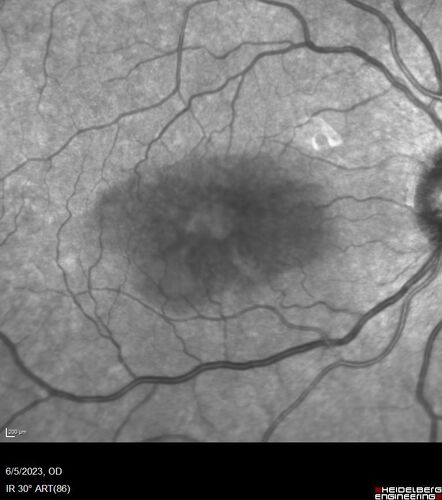 Pseudophakic cystoid macular edema (CME)
66 year old female 4 months following cataract surgery.  Never had very good vision after surgery.  On PF QID for one month.  VA 20/50 in both eyes.
