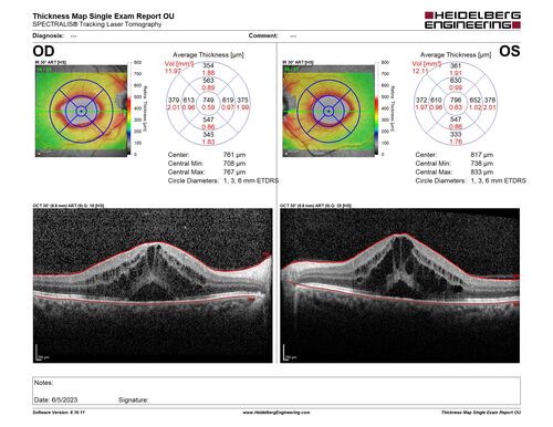 Pseudophakic cystoid macular edema (CME)
66 year old female 4 months following cataract surgery.  Never had very good vision after surgery.  On PF QID for one month.  VA 20/50 in both eyes.
