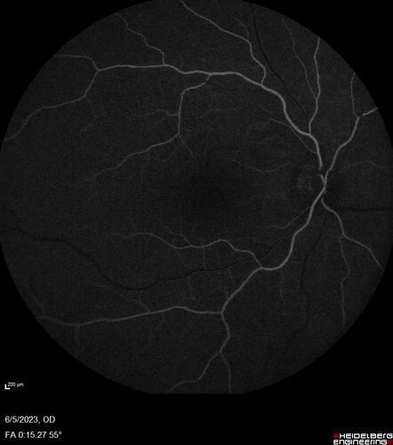 Pseudophakic cystoid macular edema (CME)
66 year old female 4 months following cataract surgery.  Never had very good vision after surgery.  On PF QID for one month.  VA 20/50 in both eyes.

