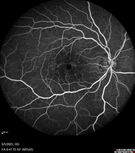 Pseudophakic cystoid macular edema (CME)
66 year old female 4 months following cataract surgery.  Never had very good vision after surgery.  On PF QID for one month.  VA 20/50 in both eyes.
