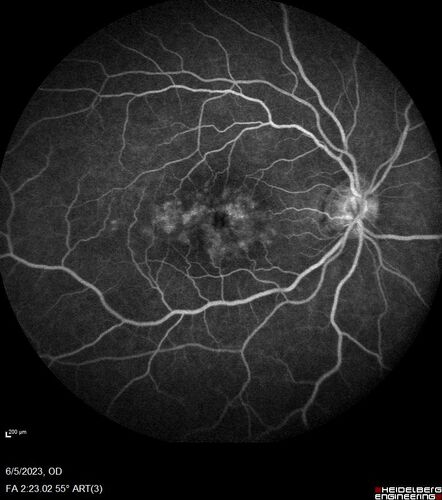 Pseudophakic cystoid macular edema (CME)
66 year old female 4 months following cataract surgery.  Never had very good vision after surgery.  On PF QID for one month.  VA 20/50 in both eyes.
