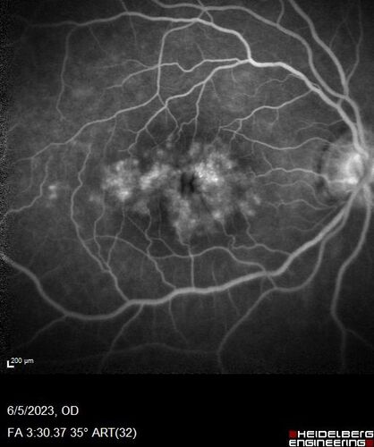 Pseudophakic cystoid macular edema (CME)
66 year old female 4 months following cataract surgery.  Never had very good vision after surgery.  On PF QID for one month.  VA 20/50 in both eyes.
