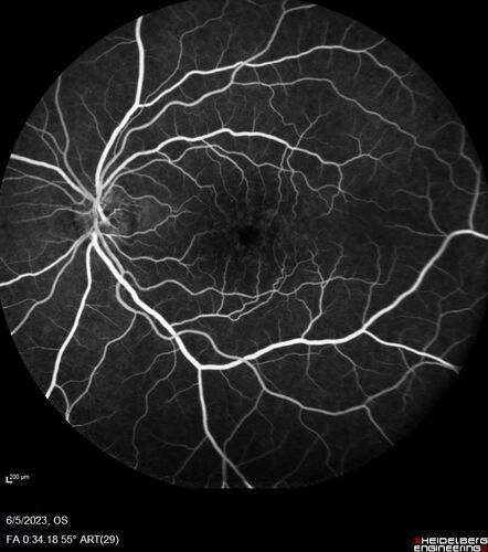 Pseudophakic cystoid macular edema (CME)
66 year old female 4 months following cataract surgery.  Never had very good vision after surgery.  On PF QID for one month.  VA 20/50 in both eyes.
