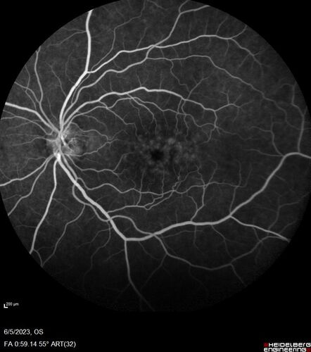 Pseudophakic cystoid macular edema (CME)
66 year old female 4 months following cataract surgery.  Never had very good vision after surgery.  On PF QID for one month.  VA 20/50 in both eyes.
