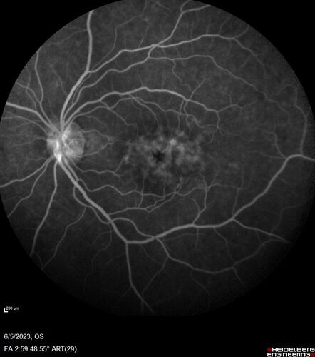 Pseudophakic cystoid macular edema (CME)
66 year old female 4 months following cataract surgery.  Never had very good vision after surgery.  On PF QID for one month.  VA 20/50 in both eyes.
