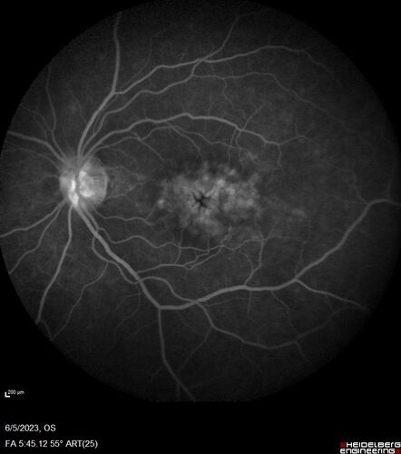 Pseudophakic cystoid macular edema (CME)
66 year old female 4 months following cataract surgery.  Never had very good vision after surgery.  On PF QID for one month.  VA 20/50 in both eyes.
