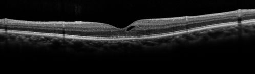 Cystoid macular edema 4 months following cataract surgery with serous retinal detachment
After Posterior sub tenon's kenalog vision improved within 1 month and IOP was fine
