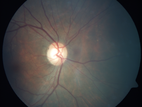 Cystoid macular edema 4 months following cataract surgery with serous retinal detachment
68 year old with 2 months of vision loss OS 20/100.  ECCE was 4 months ago.
