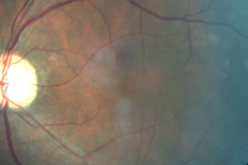 Cystoid macular edema 4 months following cataract surgery with serous retinal detachment
68 year old with 2 months of vision loss OS 20/100.  ECCE was 4 months ago.
