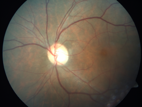 Cystoid macular edema 4 months following cataract surgery with serous retinal detachment
68 year old with 2 months of vision loss OS 20/100.  ECCE was 4 months ago.
