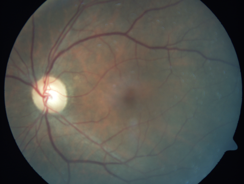 Cystoid macular edema 4 months following cataract surgery with serous retinal detachment
68 year old with 2 months of vision loss OS 20/100.  ECCE was 4 months ago.
