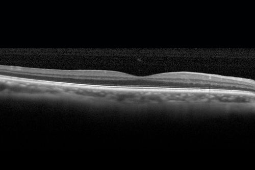 Cystoid macular edema 4 months following cataract surgery with serous retinal detachment
68 year old with 2 months of vision loss OS 20/100.  ECCE was 4 months ago.
