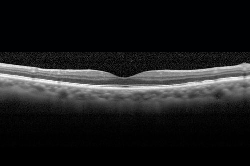 Cystoid macular edema 4 months following cataract surgery with serous retinal detachment
68 year old with 2 months of vision loss OS 20/100.  ECCE was 4 months ago.
