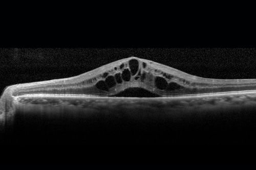 Cystoid macular edema 4 months following cataract surgery with serous retinal detachment
CME which is chronic will often cause a serous reitnal detachment because of loss of the integrity of the external limiting membrane
