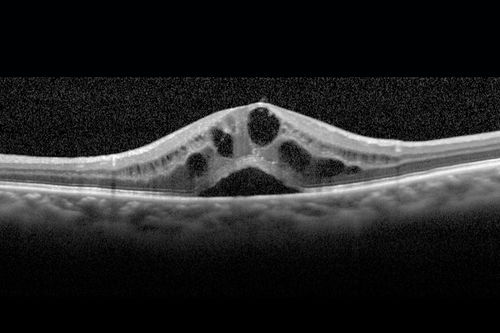 Cystoid macular edema 4 months following cataract surgery with serous retinal detachment
CME which is chronic will often cause a serous reitnal detachment because of loss of the integrity of the external limiting membrane

