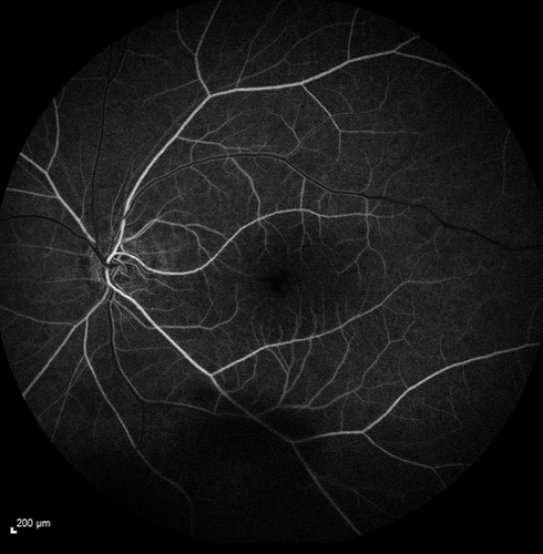 Pseudophakic CME with serous retinal detachment - FA shows leakage in both eyes
68 year old man with 2 months of vision loss.  FA shows CME, notice that the nerve also leaks.  This is typical for pseudophakic inflammatory cystoid macular edema
