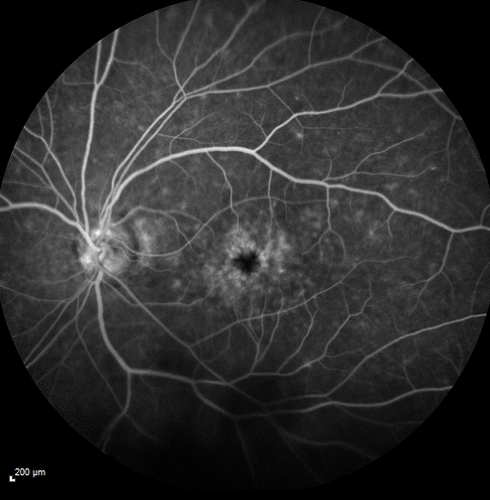 Pseudophakic CME with serous retinal detachment - FA shows leakage in both eyes
68 year old man with 2 months of vision loss.  FA shows CME, notice that the nerve also leaks.  This is typical for pseudophakic inflammatory cystoid macular edema
