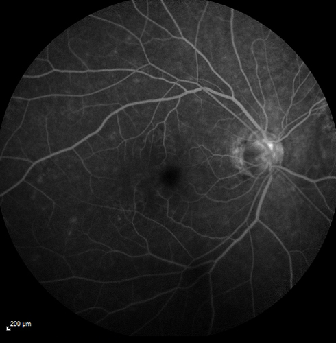 Pseudophakic CME with serous retinal detachment - FA shows leakage in both eyes
68 year old man with 2 months of vision loss.  FA shows CME, notice that the nerve also leaks.  This is typical for pseudophakic inflammatory cystoid macular edema
