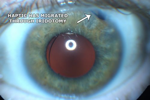 Chronic Pseudophakic Cystoid Macular Edema - Haptic Migrated into Anterior Chamber Through Peripheral Iridotomy
57-year-old man with congenital nystagmus.  He had cataract surgery done 30 years ago and has decreased vision left eye for 6 months. OD is 20/50, OS is 20/100
