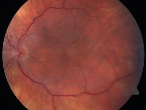 Chronic Pseudophakic Cystoid Macular Edema - Haptic Migrated into Anterior Chamber Through Peripheral Iridotomy
57-year-old man with congenital nystagmus.  He had cataract surgery done 30 years ago and has decreased vision left eye for 6 months. OD is 20/50, OS is 20/100
