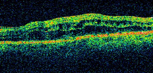 Chronic Pseudophakic Cystoid Macular Edema - Haptic Migrated into Anterior Chamber Through Peripheral Iridotomy
57-year-old man with congenital nystagmus.  He had cataract surgery done 30 years ago and has decreased vision left eye for 6 months. OD is 20/50, OS is 20/100
