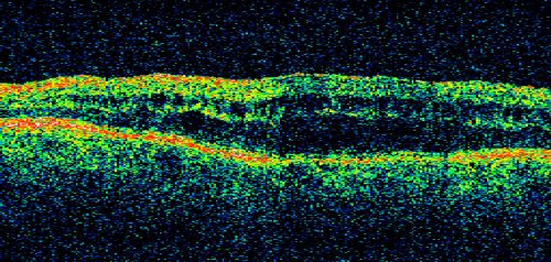 Chronic Pseudophakic Cystoid Macular Edema - Haptic Migrated into Anterior Chamber Through Peripheral Iridotomy
57-year-old man with congenital nystagmus.  He had cataract surgery done 30 years ago and has decreased vision left eye for 6 months. OD is 20/50, OS is 20/100

