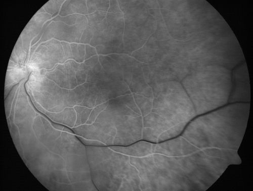 Chronic Pseudophakic Cystoid Macular Edema - Haptic Migrated into Anterior Chamber Through Peripheral Iridotomy
57-year-old man with congenital nystagmus.  He had cataract surgery done 30 years ago and has decreased vision left eye for 6 months. OD is 20/50, OS is 20/100
