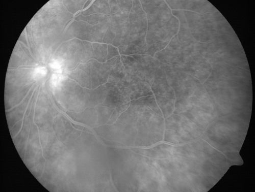 Chronic Pseudophakic Cystoid Macular Edema - Haptic Migrated into Anterior Chamber Through Peripheral Iridotomy
57-year-old man with congenital nystagmus.  He had cataract surgery done 30 years ago and has decreased vision left eye for 6 months. OD is 20/50, OS is 20/100
