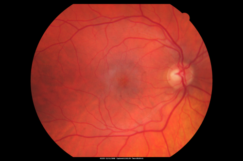 Idiopathic Cystoid Macular Edema - CME - Responded to Subtenons Kenalog - Color Photo
49-year-old man had a flu two weeks ago the right eye has been throbbing and his vision in the right eye has been foggy.  OD 20/80, OS 20/40.   IOP:  14 OU.  

Keywords: cme;cystoid macular edema;steroids;idiopathic