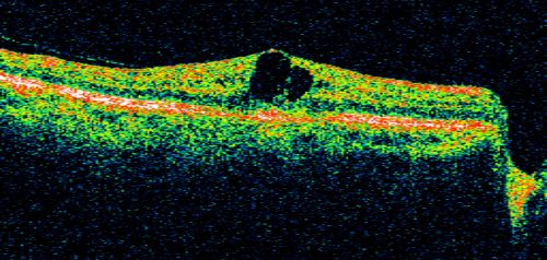 Idiopathic Cystoid Macular Edema - CME - Responded to Subtenons Kenalog - Pre Treatment Line Scan ShowingLarge  Foveal Cysts
49-year-old man had a flu two weeks ago the right eye has been throbbing and his vision in the right eye has been foggy.  OD 20/80, OS 20/40.   IOP:  14 OU.  

Keywords: cme;cystoid macular edema;steroids;idiopathic
