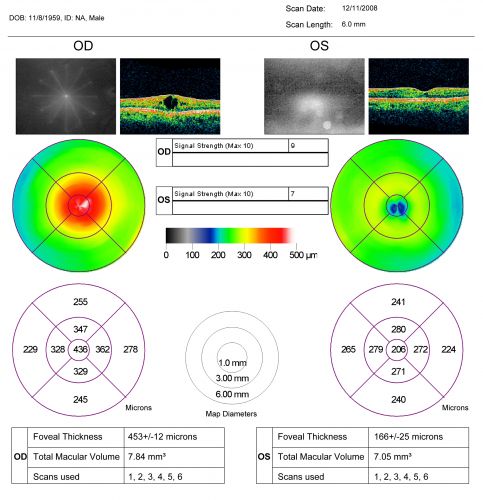 Idiopathic Cystoid Macular Edema - CME - Pre Treatment Optical Coherence Tomography Map Showing Thickened Right Macula
49-year-old man had a flu two weeks ago the right eye has been throbbing and his vision in the right eye has been foggy.  OD 20/80, OS 20/40.   IOP:  14 OU.  

Keywords: cme;cystoid macular edema;steroids;idiopathic
