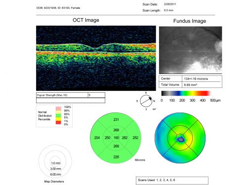 Cystoid Macular Edema - Xalatan - ECCE was done 20 years previously - 1 year later 20/40 Vision
Xalatan stopped and a brief course of topical anti-inflammatory drops was prescribed.  One year later vision is back to normal
