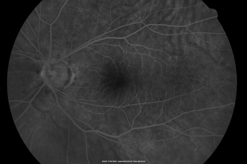 Cystoid Macular Edema - Xalatan - ECCE was done 20 years previously
71 Year old woman who noticed about a month ago the central vision in the right eye fogged up.  OD 20/200	POSSIBLE XALATAN INDUCED CYSTOID MACULAR EDEMA, 
Schlüsselwörter: cme;xalatan