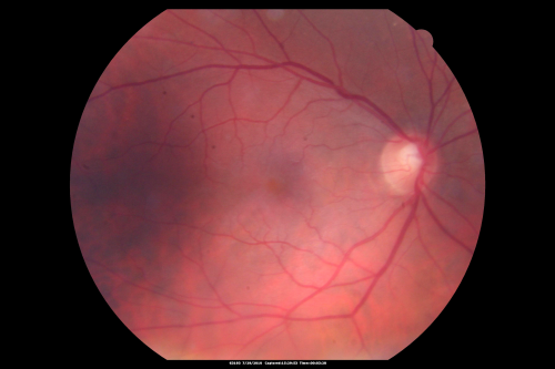 Cystoid Macular Edema - Xalatan - ECCE was done 20 years previously
71 Year old woman who noticed about a month ago the central vision in the right eye fogged up.  OD 20/200	POSSIBLE XALATAN INDUCED CYSTOID MACULAR EDEMA 
Keywords: cme;xalatan