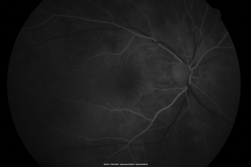 Cystoid Macular Edema - Xalatan - ECCE was done 20 years previously
71 Year old woman who noticed about a month ago the central vision in the right eye fogged up.  OD 20/200	POSSIBLE XALATAN INDUCED CYSTOID MACULAR EDEMA 
Palabras clave: cme;xalatan