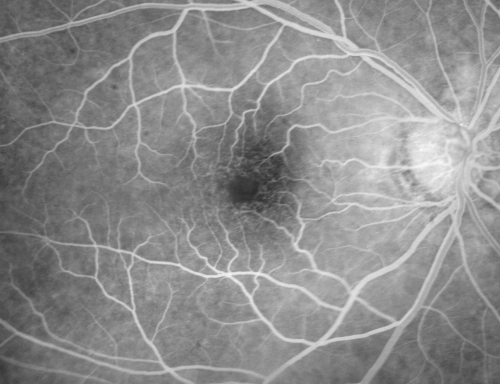 Cystoid Macular Edema - Xalatan - ECCE was done 20 years previously
71 Year old woman who noticed about a month ago the central vision in the right eye fogged up.  OD 20/200	POSSIBLE XALATAN INDUCED CYSTOID MACULAR EDEMA 
Keywords: cme;xalatan