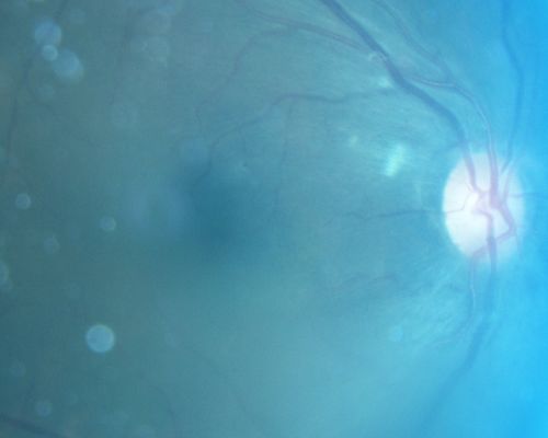 Cytomegalovirus Retinitis - Partially Treated and AIDS retinopathy
44-year-old man a month agoe was diagnosed with HIV and he had pneumonia.  He has had blurred vision for about a month, more in the left eye than the right eye. He has not yet seen anyone to start anti-AIDS therapy.  He was given a medical doctor's name for a follow-up visit.  He thinks his CD4 count is somewhere in the low 100s.   Vision OU is 20/30
