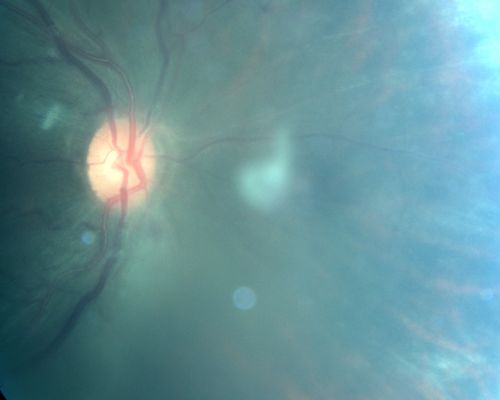 Cytomegalovirus Retinitis - Partially Treated and AIDS retinopathy
44-year-old man a month agoe was diagnosed with HIV and he had pneumonia.  He has had blurred vision for about a month, more in the left eye than the right eye. He has not yet seen anyone to start anti-AIDS therapy.  He was given a medical doctor's name for a follow-up visit.  He thinks his CD4 count is somewhere in the low 100s.   Vision OU is 20/30
