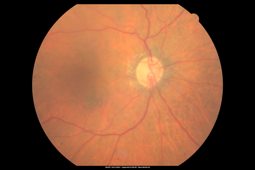 Non-exudative wet AMD right eye (treatment naive quiescent)
82 year old man.  ICG shows CNVM in the right eye.  This stayed quiet for 3 years and then started leaking and responded well to Avastin.
