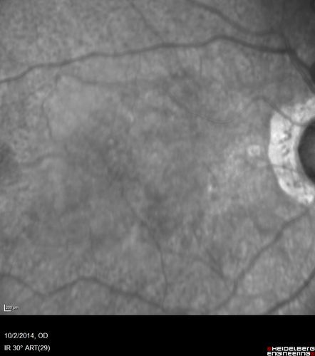 Non-exudative wet AMD right eye (treatment naive quiescent)
82 year old man.  ICG shows CNVM in the right eye.  This stayed quiet for 3 years and then started leaking and responded well to Avastin.

