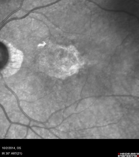 Non-exudative wet AMD right eye (treatment naive quiescent)
82 year old man.  ICG shows CNVM in the right eye.  This stayed quiet for 3 years and then started leaking and responded well to Avastin.
